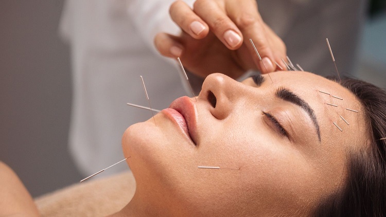 Acupuncture